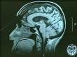 De la vitamine E pour lutter contre Parkinson De la vitamine E pour lutter contre Parkinson