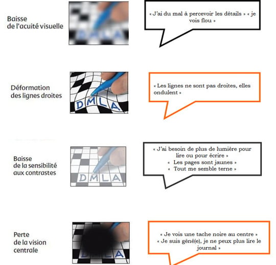 Dégénérescence Maculaire Liée à l’Age (DMLA) : une urgence médicale Dégénérescence Maculaire Liée à l’Age (DMLA) : une urgence médicale