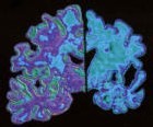 Alzheimer : des chercheurs identifient un mécanisme naturel de défense contre cette maladie Alzheimer : des chercheurs identifient un mécanisme naturel de défense contre cette maladie