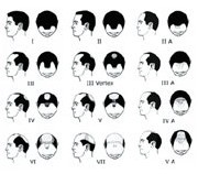FUE, une nouvelle technique pour corriger les calvities débutantes ou moyennes FUE, une nouvelle technique pour corriger les calvities débutantes ou moyennes