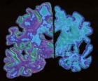 Espagne – Un projet pilote de traitement d’Alzheimer en Catalogne Espagne – Un projet pilote de traitement d’Alzheimer en Catalogne