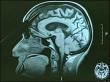 Espagne : les conséquences de la maladie d'Alzheimer sur les proches Espagne : les conséquences de la maladie d'Alzheimer sur les proches