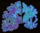 États-Unis – Alzheimer : le marché de thérapies pourrait connaître une explosion États-Unis – Alzheimer : le marché de thérapies pourrait connaître une explosion