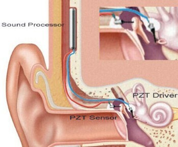 Traitement de la surdité : un nouvelle prothèse auditive totalement implantable Traitement de la surdité : un nouvelle prothèse auditive totalement implantable