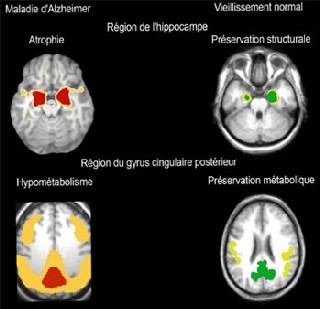 Les régions cérébrales les plus atteintes sur le plan structural et fonctionnel dans la maladie d'Alzheimer (en rouge, à gauche) correspondent aux régions les mieux préservées au cours du vieillissement normal (en vert, à droite). Les régions cérébrales les plus atteintes sur le plan structural et fonctionnel dans la maladie d'Alzheimer (en rouge, à gauche) correspondent aux régions les mieux préservées au cours du vieillissement normal (en vert, à droite).