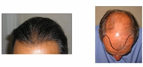 La chute des cheveux la démangeaison de la peau de la tête