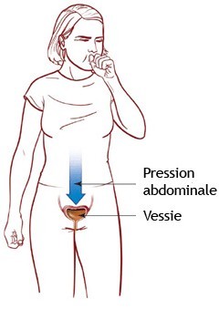 L'incontinence urinaire d'effort chez les seniors L'incontinence urinaire d'effort chez les seniors