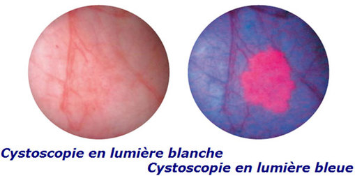 Cancer de la vessie : cystoscopie de fluorescence, une nouvelle technique de diagnostic Cancer de la vessie : cystoscopie de fluorescence, une nouvelle technique de diagnostic