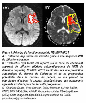 AVC : une nouvelle technique d'IRM pour prévoir l'évolution des infarctus cérébraux AVC : une nouvelle technique d'IRM pour prévoir l'évolution des infarctus cérébraux