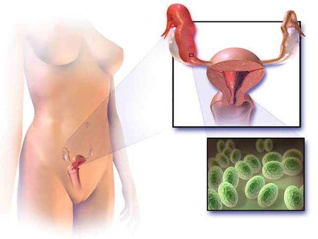 Cancer des ovaires : un cancer relativement peu fréquent mais à fort risque de récidive