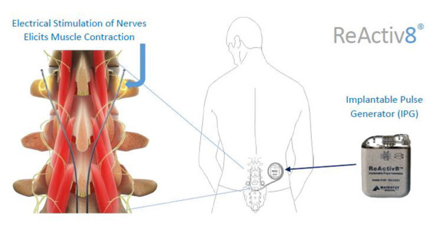 La lombalgie : un nouveau dispositif pour soulager la douleur La lombalgie : un nouveau dispositif pour soulager la douleur