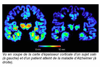 Alzheimer : l'épaisseur de la matière grise, témoin précoce de la maladie Alzheimer : l'épaisseur de la matière grise, témoin précoce de la maladie