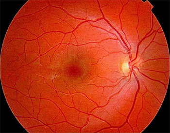 DMLA : le parcours du patient atteint de cette maladie oculaire