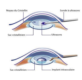 La chirurgie multifocale : pour mieux voir de près comme de loin après 40 ans La chirurgie multifocale : pour mieux voir de près comme de loin après 40 ans
