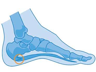 Aponévrosite plantaire, épine calcanéenne : d’où vient la douleur et que faire ? Aponévrosite plantaire, épine calcanéenne : d’où vient la douleur et que faire ?