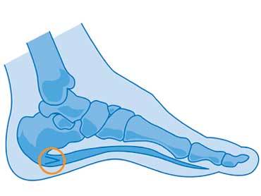 Aponévrosite plantaire, épine calcanéenne : d'où vient la douleur ...