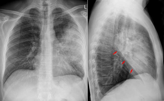 BPCO : mieux connaître cette maladie pulmonaire chronique qui survient après 45 ans
