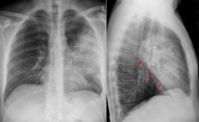 BPCO : mieux connaître cette maladie pulmonaire chronique qui survient après 45 ans BPCO : mieux connaître cette maladie pulmonaire chronique qui survient après 45 ans