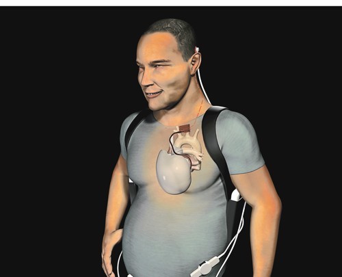 Carmat, DR Carmat, DR