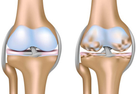 genou sain à gauche et genou avec arthrose à droite