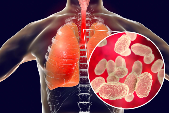 Personne infectée par la coqueluche ©Shutterstock