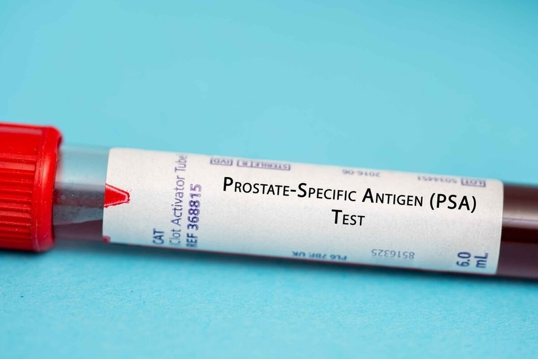 Test du taux de PSA pour diagnostiquer la récidive d'un cancer prostatique © luchschenF/Shutterstock