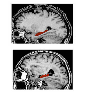 En bas, hippocampe d’un patient atteint de la maladie d’Alzheimer. Copyright O. Colliot