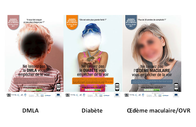 JNM : le point sur la maculopathie diabétique avec l'association Macula JNM : le point sur la maculopathie diabétique avec l'association Macula