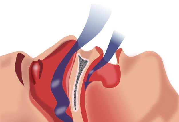 Apnée du sommeil : le rôle du chirurgien-dentiste Apnée du sommeil : le rôle du chirurgien-dentiste