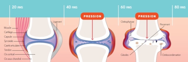 Douleurs articulaires et surpoids : le point avec le docteur Bertrand Moura Douleurs articulaires et surpoids : le point avec le docteur Bertrand Moura