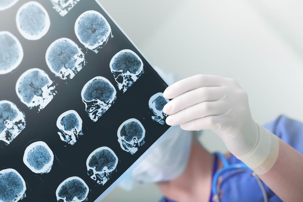 The French technology of motor rehabilitation after a stroke is leaving its mark all over the world The French technology of motor rehabilitation after a stroke is leaving its mark all over the world