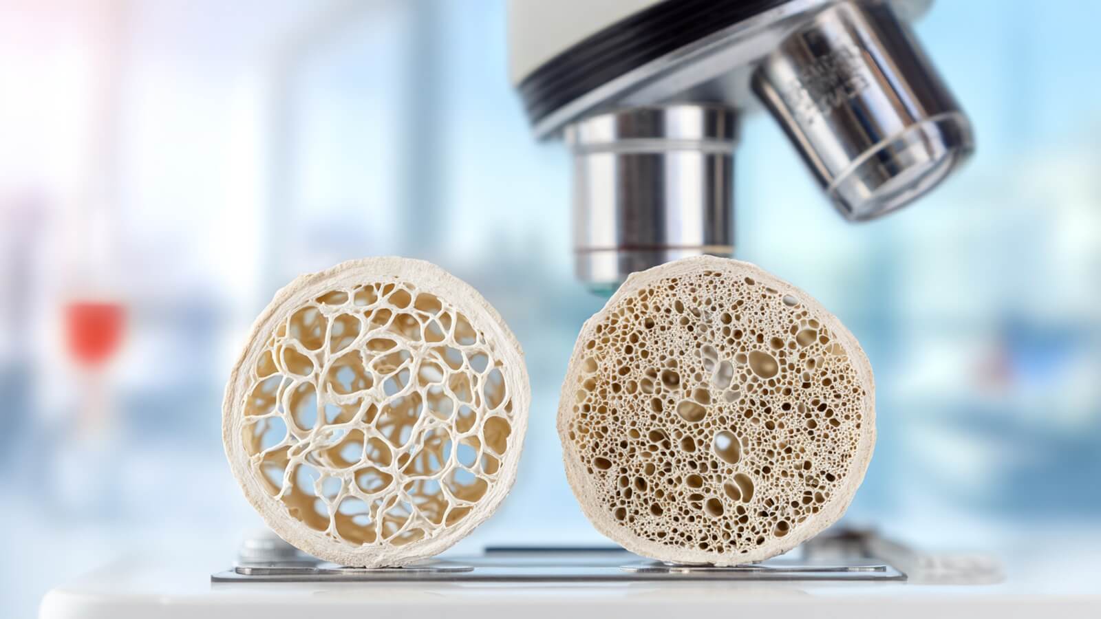 Ostéoporose : perspective de traitements capables de reconstruire l'os fragilisé des femmes ménopausées