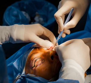 Blépharoplastie : une nouvelle technique sans chirurgie grâce au laser CO2
