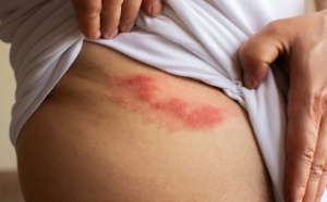 Le zona et ses complications neurologiques