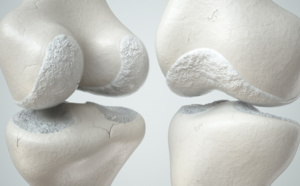 Gonarthrose : symptômes, diagnostic et traitements