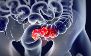 Cancer colorectal : des kits de dépistage disponibles en pharmacie