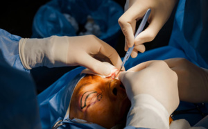 Blépharoplastie : une nouvelle technique sans chirurgie grâce au laser CO2