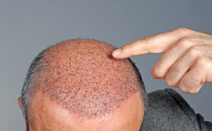 Greffe de cheveux : rester en France ou partir en Turquie ?