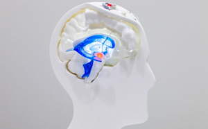 Parkinson : une avancée majeure avec l'implantation d'un dispositif innovant