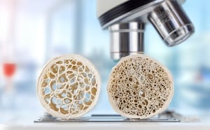 Ostéoporose : cette découverte allemande pourrait faire repousser les os fragilisés