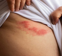 Le zona et ses complications neurologiques