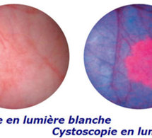 Cancer de la vessie : cystoscopie de fluorescence, une nouvelle technique de diagnostic