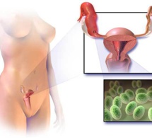 Cancer des ovaires : un cancer relativement peu fréquent mais à fort risque de récidive