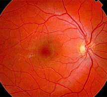DMLA : le parcours du patient atteint de cette maladie oculaire