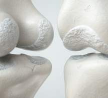 Gonarthrose : symptômes, diagnostic et traitements