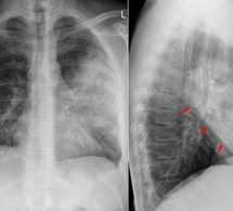 BPCO : mieux connaître cette maladie pulmonaire chronique qui survient après 45 ans