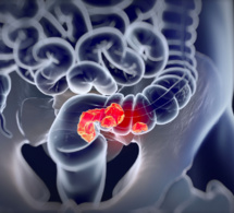 Cancer colorectal : des kits de dépistage disponibles en pharmacie