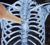 Autriche : première pose d'un implant sternal en céramique sur une patiente septuagénaire