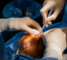 Blépharoplastie : une nouvelle technique sans chirurgie grâce au laser CO2