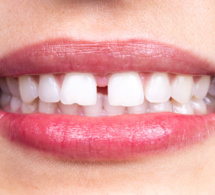 Diastème : tout comprendre sur ce problème de dent